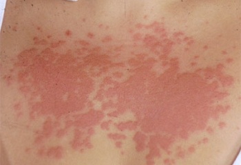 Солнечная аллергия
