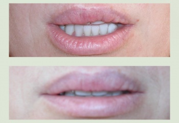 Контурная хейлопластика: как увеличить губы при помощи инъекций
