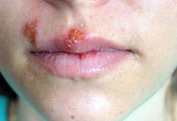 Герпес — не только маленькая болячка на губе