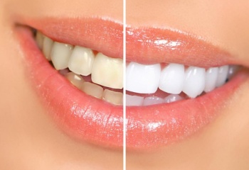 Как отбелить зубы в клинике 