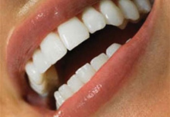 Как отбелить эмаль зубов